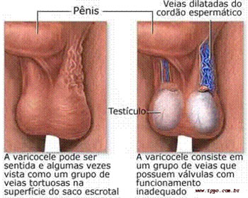 Varicocele