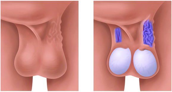 varicocele