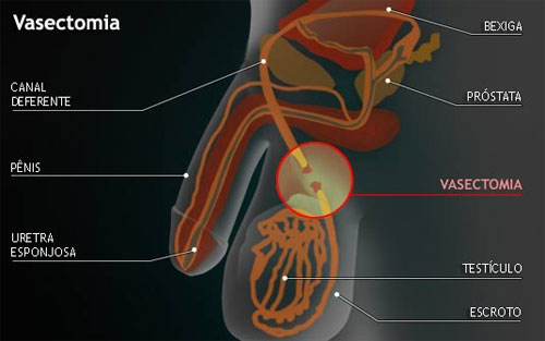 Gravidez aps a vasectomia